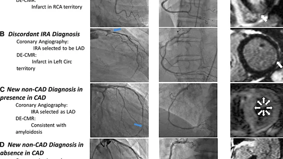 Cardiac MRI vs angiography for NSTEMI diagnosis. Cardiac MRI may better assess and treat patients who have experienced a type of heart attack caused by an extremely narrowed artery compared to standard angiography, reported a study published in Circulation. Overall, MRI led to a new diagnosis involving a damaged artery in 30% of patients, and a diagnosis unrelated to the artery in another 15%.