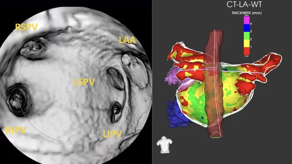 CT has been used for planning and procedural guidance in pulmonary vein isolation (PVI) for about 20 years. It shows the anatomy to the electrophysiologist. The EPs also can load the imaging into their EP mapping system. It also shows them the location of the esophagus and the phrenic nerve so they can avoid these during the procedures. #PVI #EPeeps