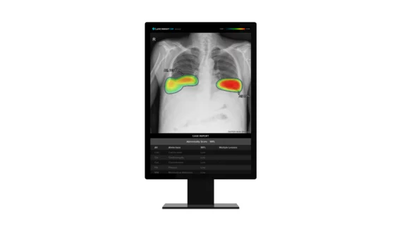Lunit AI chest X-rays