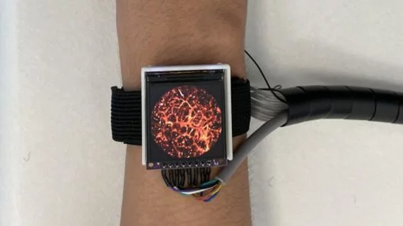 photoacoustic imaging watch