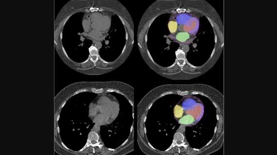Advanced artificial intelligence (AI) models can evaluate cardiovascular risk in routine chest CT scans without contrast, according to new research published in Nature Communications.[1] In fact, the authors noted, the AI approach may be more effective at identifying issues than relying on guidance from radiologists. Representative non-contrast CT slices for two patients (left), with super-imposed segmentations (right). One artificial intelligence (AI) model was used to segment a cardiac mask.