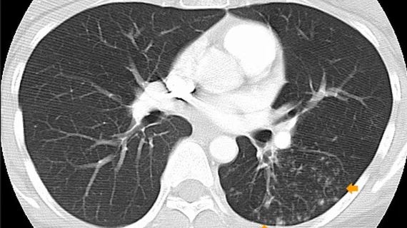 lung CT