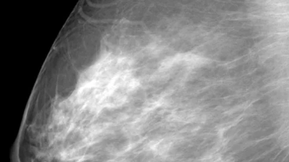 Women with dense breasts and benign breast disease have increased risks of developing #breastcancer